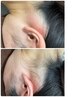 見られてますよ！？［うなじ脱毛］¥3000 before after の変化がすごい！！