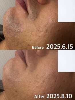 ベール(BEHL)/髭脱毛のBefore After