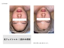 イル 名取店(iru)/光フェイシャル