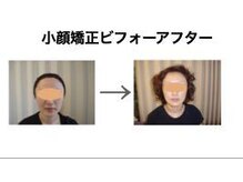 やち鍼灸院/小顔矯正でフェイスアップ！