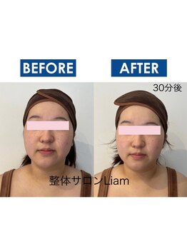 リアン(Liam)/小顔矯正