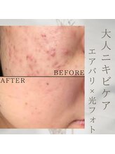 美バリ 新宿店(美BARI)/エアバリ×光フォト　5回