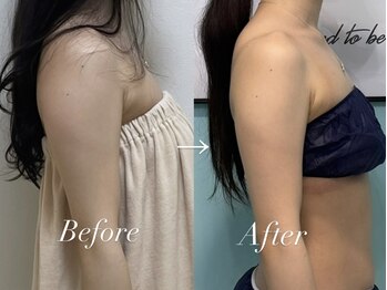 ビーナスアイスブルー(Venus ICE BLUE)/背中と二の腕脂肪冷却