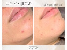 スリースリー(THREE THREE)/ニキビ・肌荒れ