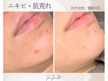 スリースリー(THREE THREE)/ニキビ・肌荒れ