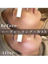 エピナ 横浜店(Epina)/顔脱毛×ハーブピーリング