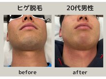 エピリス(EPILIS)/ヒゲ脱毛効果！青ヒゲ解消！