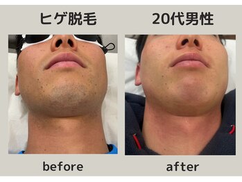 エピリス(EPILIS)/ヒゲ脱毛効果！青ヒゲ解消！