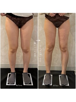 OBS新潟整骨院/新潟初の脂肪冷却PROで美脚に