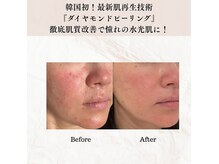 韓国から初上陸！最新美容ダイヤモンドピーリングで水光肌に