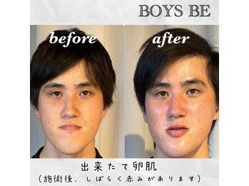 オンリーケア バイ ボーイズビー(ONLY CARE by Boys Be)/bubble毛穴洗浄(小鼻)