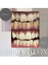 リベラサロン(LIBERA SALON)/ヤニ、黄ばみに効果的◎清潔感◎