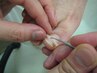【巻き爪の痛みもう我慢しない！】巻き爪矯正コース　１本