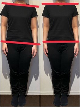 ブライダルエステ バイ スイスパ表参道(BRIDAL ESTHE by SUI SPA)/【骨盤矯正】歪み Before→After