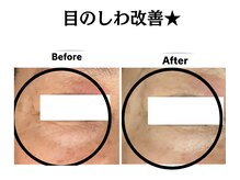 グレースティー 森町 箕面/目周りのしわ改善★