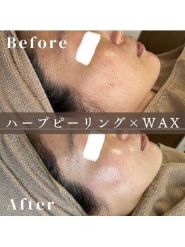 エピナ 横浜店(Epina)/顔脱毛×ハーブピーリング