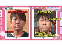 さつま骨格矯正 HRD広尾 西麻布院 /「ななに一地下ABEMA」に出演☆