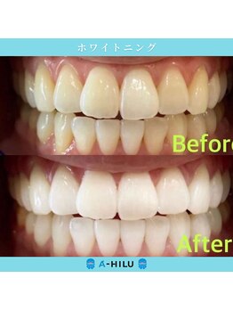 アーヒル(A”-HILU)/ホワイトニング