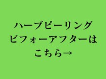 ア クーユ 相模大野店/ハーブピーリング/ニキビケア