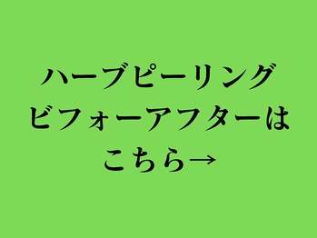 ア クーユ 相模大野店/ハーブピーリング/ニキビケア