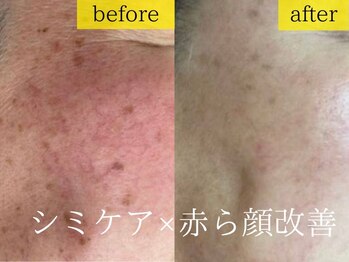 エステの森ジュジュ/【シミケア】ビフォーアフター