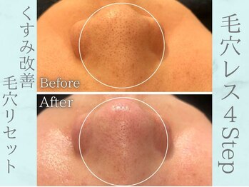 ネオファースト(NeoFirst)/頑固な毛穴詰まりも綺麗スッキリ