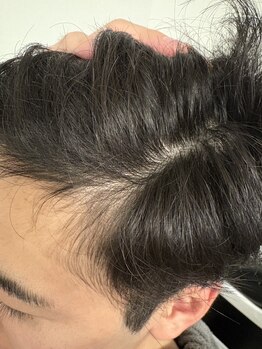 リメル(Remell)/育毛促進 60代男性