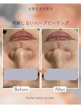 ラシック 加古川店(La chic.)/ハーブピーリングで黒ずみ解消