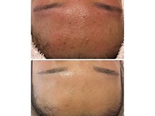 1回でこの変化！敏感肌さんも安心の毛穴ケアトリートメント♪