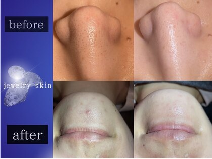 ジュエリースキン(JewelrySkin)の写真