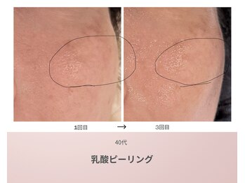 リアン(Lien)/40代　ビフォーアフター