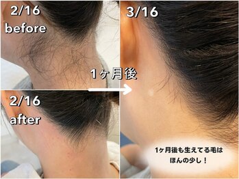 サロンネム(Salon Nem)/うなじW脱毛