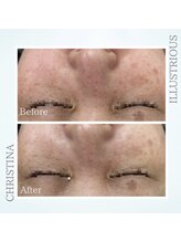 シャルムパリス(charme paris)/本気の美白◎１回の施術変化