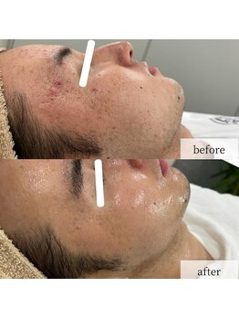 ヴィーナス(Venus)/エステ版ポテンツァ　5回