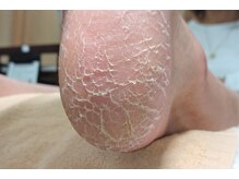 あいの巻き爪補正所