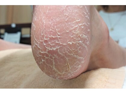 あいの巻き爪補正所の写真