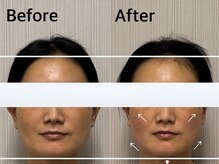 ベール(BEHL)/コルギのBefore After