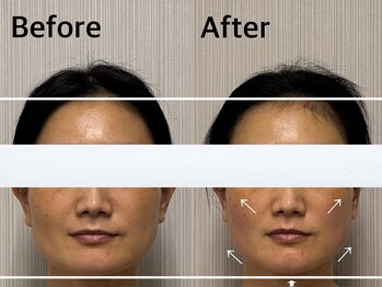 ベール(BEHL)/コルギのBefore After