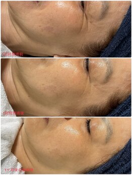 クロッシュ(Cloche)/光フォト＋エクソソームハーブ