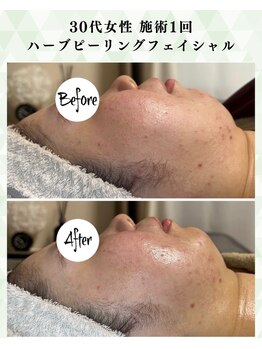 シーフェイス 横浜店(SEE FACE)/肌質改善ニキビハーブピーリング