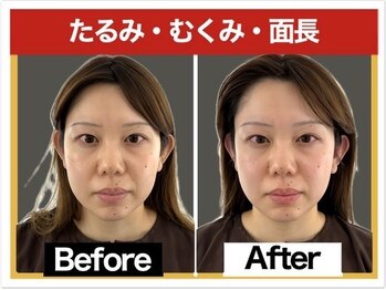 エレヴィザ トウキョウ 恵比寿院(ELVISA TOKYO)/たるみ・むくみ・面長が気になる