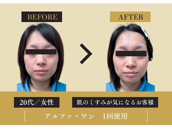 キレイ 筑紫野原田店(KIREI)/20代 肌のくすみが気になる