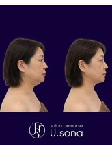 小顔・脂肪コントロール専門 salon de nurse U.sona～松本店～/【顔造形】50代脂肪分解症例