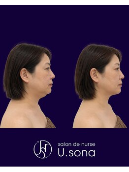 小顔・脂肪コントロール専門 salon de nurse U.sona～松本店～/【顔造形】50代脂肪分解症例