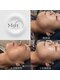 メルト 中目黒(Melt.)の写真/たるみ・フェイスラインに。都内一台の医師共同開発モデルの高出力サーマジェン。骨格に合わせ丁寧に照射。