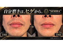 シンバ 南草津店(SIMBA)の雰囲気（【実際のお客様】青ヒゲが薄くなり、朝髭剃りが楽になったと好評）