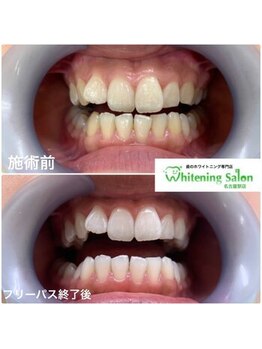 ホワイトニングサロン 名古屋駅店/【ホワイトニング施術例】