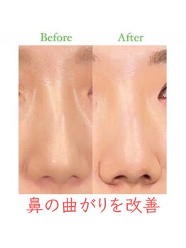 ラプリ 福岡天神店(Raplit)/隆鼻+輪郭・小顔矯正 美鼻/小顔
