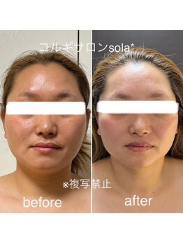 ソラ(sola*)/スッキリ小顔コルギ