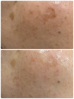 ギャラクシービューティー(galaxy beauty)/シミケア